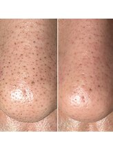 エピシアドットエヌ(epicia.N)/お鼻もこれでスッキリ