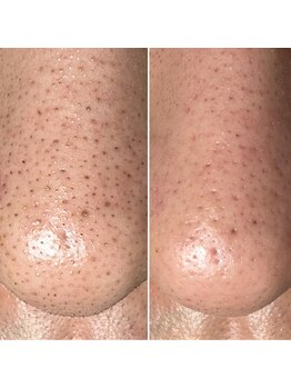 エピシアドットエヌ(epicia.N)/お鼻もこれでスッキリ