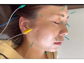 鍼灸整骨院ナガサキ(nagasaki)/女性だから分かる美容鍼