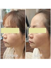 ユフラ(Yufla)/ヘッドマッサージ1回での結果