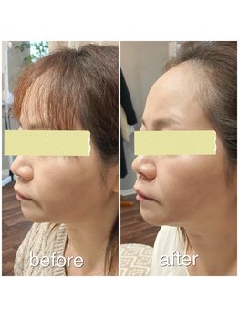 ユフラ(Yufla)/ヘッドマッサージ1回での結果