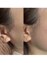 シャローム アローヴ(shalom alob)/フェイスワックス脱毛