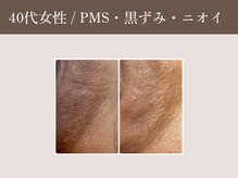 ラウン 京都(ROUN')/1回の施術のビフォーアフター