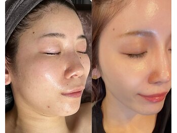 フェイスプラスリフ(FACE+RiF)/たるみ改善 くすみ