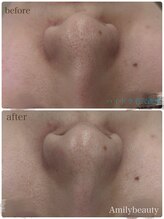アミリービューティー ひたち野うしく店(Amily beauty)/ハイドラ毛穴洗浄
