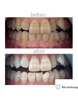 NAホワイトニング 自由が丘店/【before/after】