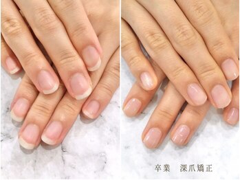 リファーレ(RIFARE)/【深爪矯正】見た目が変わる！