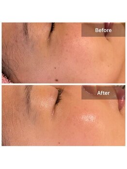 サロンドデュイ/1回施術/20代/乾燥肌/ブライダル