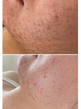 美時雨/ニキビにお悩みの方！