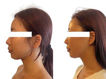 エニ(Eni)/顎ラインを引き締める☆