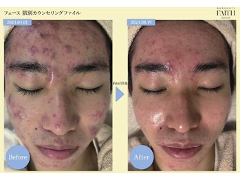 リノア 堀江(Linoa)/4ヶ月半後 before→after