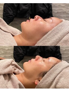 ビュウナ 銀座(BEAUNA)/マルチウェーブリフト