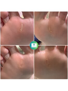 リゼラアンドコー たまプラーザ店/フットキュアコース