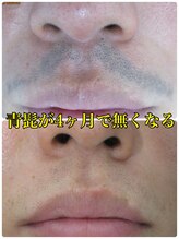 美容脱毛専門サロン エピラージュ 新宿店(Epilage)/青髭もお任せ！