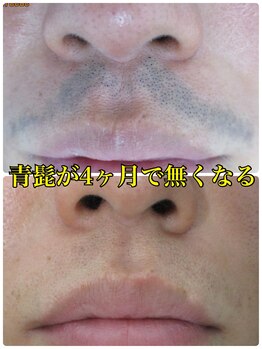 美容脱毛専門サロン エピラージュ 新宿店(Epilage)/青髭もお任せ！