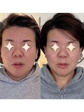 小顔22 ボルティ 本店(Bolty)/【悩み】50代・顔のたるみ