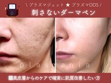 ラ ラナン(La lanun)の雰囲気（プラズマジェット×プラズマDDS【２種のプラズマを使用】）