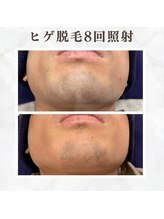 ボゴス(BOGOSS)/ヒゲ脱毛8回照射