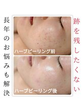 サロンド アーク(Salon de ARC)/剥離なしハーブピーリング