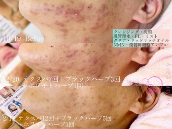 ヴェアリー 広尾(VARY)/４ヶ月集中ケア　ハーブ6回