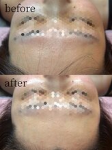 リレイスフクオカ(RelaceFUKUOKA)/ララピール×顔脱毛