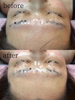 リレイスフクオカ(RelaceFUKUOKA)/ララピール×顔脱毛