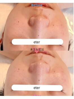 エテル(eter)/PHA水光ピール　20代女性/1回目