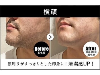 RBL 大宮店/メンズ脱毛/ヒゲ脱毛1回目剃毛後