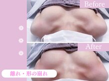 キアナ 横浜店(Kiana)/離れにお悩みの方Before After