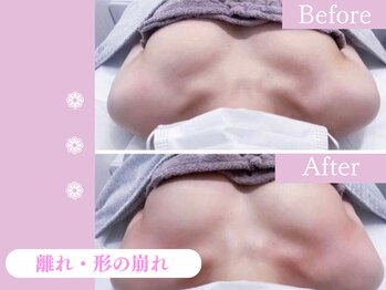 キアナ 横浜店(Kiana)/離れにお悩みの方Before After