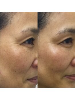 リンク 錦糸町店(Link)/54歳！1ヶ月で目尻のしわ改善！