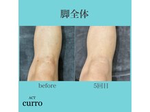 アクト クロ(ACT curro)/【脚全体】脱毛施術例
