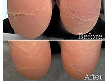 カシェット 広島店(Cachette)/20代女性☆足裏角質ケア90分