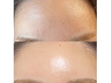 ソフトダーマのbefore→after☆一度でこの変化を体感できます！