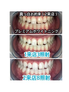 プラチナムビューティ 四条烏丸店(PLATINUM Beauty)/2来店70分照射!Before/After！