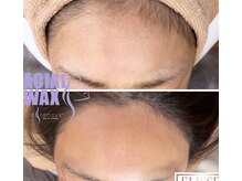 エリス(ELISSE)/ワックスと顔脱毛のW脱毛！