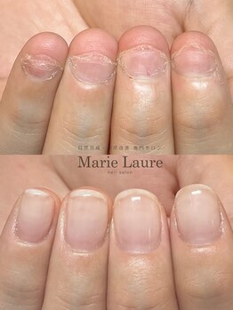 マリーロール 梅田店(Marie Laure)/自爪育成/深爪矯正/ネイルケア