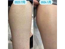 エピシアドットエヌ(epicia.N)/ツルツルお肌に！