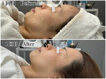 エミマス ボーテ(Emimas Beaute’)/４０代前半　毛穴洗浄＆幹細胞