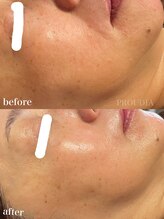 プラウディア(PROUDIA)/シミケア/エイジング/ほうれい線