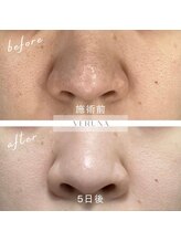 リレア ラカ(Relair Laka)/ハードハーブピーリング