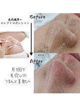 ルミナエステ(LUMINA ESTH)/毛穴／毛穴洗浄／毛穴ケア｜症例