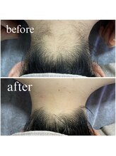 クレセント(crescent)/襟足脱毛