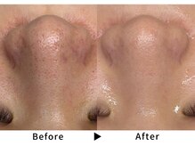 エミエル(EMIER)の雰囲気（【毛穴開き/黒ずみ◎】キメ細かい肌質と透明感を引き出します♪）