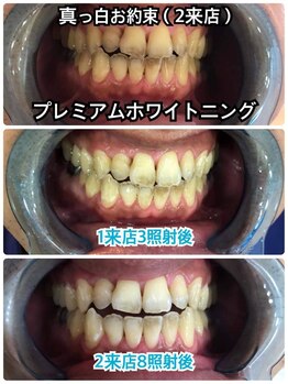 プラチナムビューティ 四条烏丸店(PLATINUM Beauty)/2来店70分照射!Before/After！