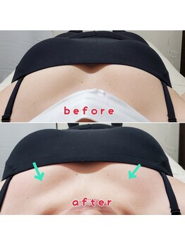 サンイチゼロ(310)/猫背矯正before→after