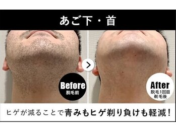 RBL 大宮店/メンズ脱毛/ヒゲ脱毛1回目剃毛後