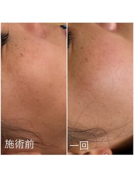 セメヴェール(Saimervell)/昔からの悩みもしみケアで改善！