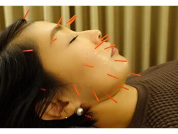 中国鍼灸院 はこしま医針堂/ベーシック美容鍼