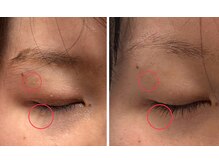 オーパーツ(OOPARTS)/血流ケアでイボの改善